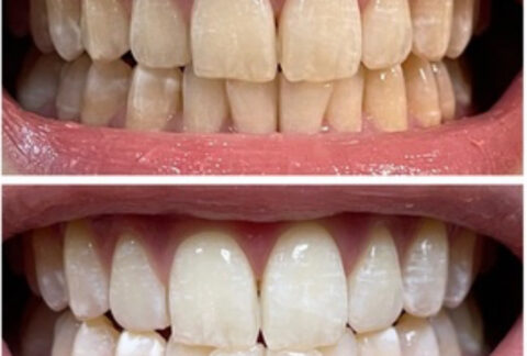Teeth Whitening